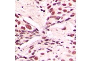 Immunohistochemical analysis of LMX1B staining in human breast cancer formalin fixed paraffin embedded tissue section. (LMX1B antibody  (Center))