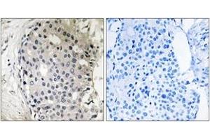 Immunohistochemistry analysis of paraffin-embedded human breast carcinoma tissue, using ARHGEF10 Antibody. (ARHGEF10 antibody  (AA 339-388))