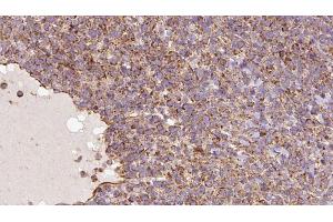 ABIN6273182 at 1/100 staining Human lymph cancer tissue by IHC-P. (UQCRC1 antibody  (C-Term))