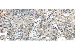 Immunohistochemistry of paraffin-embedded Human breast cancer tissue using FUS Polyclonal Antibody at dilution 1:45 (FUS antibody)