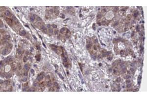 ABIN6273882 at 1/100 staining Human liver cancer tissue by IHC-P. (GPR55 antibody  (Internal Region))