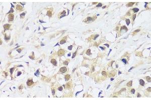 Immunohistochemistry of paraffin-embedded Human breast cancer using ASCL4 Polyclonal Antibody at dilution of 1:100 (40x lens). (ASCL4 antibody)