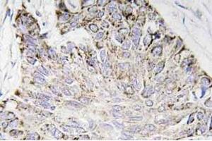Immunohistochemistry (IHC) analyzes of Caspase-4 antibody in paraffin-embedded human lung carcinoma tissue. (Caspase 4 antibody)