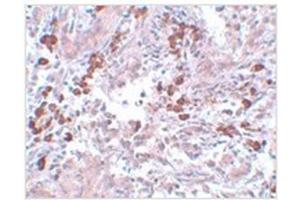 Immunohistochemistry of BCAS1 in human breast carcinoma with BCAS1 antibody at 5 µg/ml.