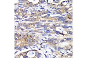 Immunohistochemistry of paraffin-embedded human gastric cancer using H antibody (ABIN6129787, ABIN6141601, ABIN6141603 and ABIN6216048) at dilution of 1:100 (40x lens). (HAPLN1 antibody  (AA 165-354))