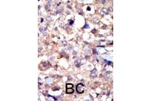 Formalin-fixed and paraffin-embedded human cancer tissue reacted with the primary antibody, which was peroxidase-conjugated to the secondary antibody, followed by AEC staining. (ABL1 antibody  (C-Term))