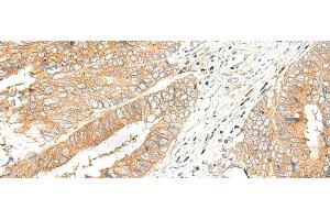 Immunohistochemistry of paraffin-embedded Human colorectal cancer tissue using GPR151 Polyclonal Antibody at dilution of 1:45(x200) (GPR151 antibody)