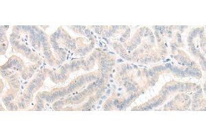 Immunohistochemistry of paraffin-embedded Human thyroid cancer tissue using AOAH Polyclonal Antibody at dilution of 1:25(x200) (AOAH antibody)