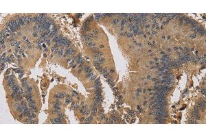 Immunohistochemistry of paraffin-embedded Human colon cancer using KIF22 Polyclonal Antibody at dilution of 1:30 (KIF22 antibody)