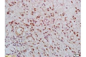 Formalin-fixed and paraffin embedded human gastric carcinoma labeled with Rabbit Anti KLK8 Polyclonal Antibody, Unconjugated (ABIN759116) at 1:200 followed by conjugation to the secondary antibody and DAB staining (Kallikrein 8 antibody  (AA 51-150))