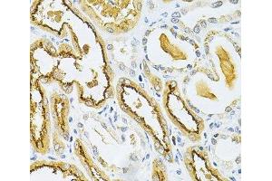 Immunohistochemistry of paraffin-embedded Human kidney cancer using GLRX Polyclonal Antibody at dilution of 1:200 (40x lens). (Glutaredoxin 1 antibody)