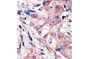 Formalin-fixed, Paraffin-embedded human cancer tissue stained with MAPK10 Antibody (N-term) Cat. (MAPK10 antibody  (N-Term))