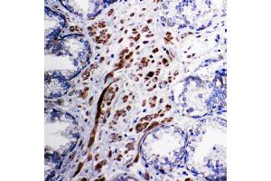 Anti-Mitochondrial Pyruvate dehydrogenase kinase 1 antibody, IHC(P) IHC(P): Human Prostatic Cancer Tissue (PDPK1 antibody  (C-Term))