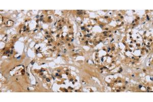 Immunohistochemistry of paraffin-embedded Human thyroid cancer tissue using LGALS7 Polyclonal Antibody at dilution 1:50 (LGALS7 antibody)