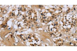 Immunohistochemistry of paraffin-embedded Human thyroid cancer tissue using LGALS7 Polyclonal Antibody at dilution 1:50