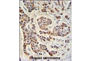 ATHL1 Antibody (C-term) (ABIN1881084 and ABIN2840111) IHC analysis in formalin fixed and paraffin embedded human breast carcinoma followed by peroxidase conjugation of the secondary antibody and DAB staining. (ATHL1 antibody  (C-Term))