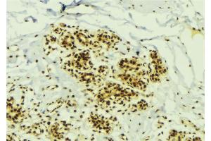 ABIN6273799 at 1/100 staining Human breast cancer tissue by IHC-P. (NEK2 antibody  (Internal Region))