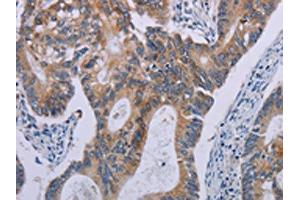 The image on the left is immunohistochemistry of paraffin-embedded Human colon cancer tissue using ABIN7190614(F2RL2 Antibody) at dilution 1/30, on the right is treated with synthetic peptide. (F2RL2 antibody)