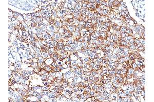 Formalin-fixed, paraffin-embedded human Breast Carcinoma stained with EpCAM Mouse Monoclonal Antibody (EGP40/826). (EpCAM antibody  (N-Term))