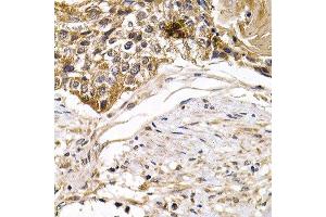 Immunohistochemistry of paraffin-embedded human breast cancer using ARRB2 antibody at dilution of 1:200 (400x lens). (Arrestin 3 antibody)