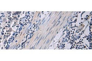 Immunohistochemistry of paraffin-embedded Human esophagus cancer tissue using ANGPTL2 Polyclonal Antibody at dilution of 1:55(x200) (ANGPTL2 antibody)