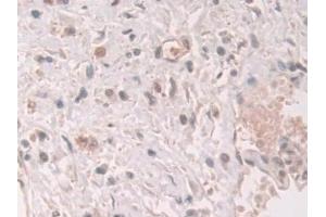 Detection of GCA in Human Prostate cancer Tissue using Polyclonal Antibody to Grancalcin (GCA) (Grancalcin antibody  (AA 1-139))
