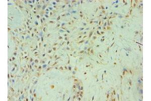 Immunohistochemistry of paraffin-embedded human breast cancer using ABIN7152459 at dilution of 1:100 (TBL1XR1 antibody  (AA 1-180))