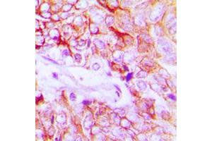 Immunohistochemical analysis of HER4 (pY1284) staining in human breast cancer formalin fixed paraffin embedded tissue section. (ERBB4 antibody  (C-Term, pTyr1284))