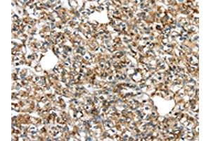 The image on the left is immunohistochemistry of paraffin-embedded Human prostate cancer tissue using ABIN7131341(TGM4 Antibody) at dilution 1/20, on the right is treated with fusion protein. (TGM4 antibody)