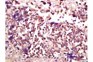 Formalin-fixed and paraffin embedded human lung carcinoma labeled with Anti-E2F3 Polyclonal Antibody, Unconjugated (ABIN733493) at 1:200 followed by conjugation to the secondary antibody and DAB staining (E2F3 antibody  (AA 381-465))