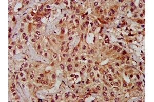 IHC image of ABIN7159972 diluted at 1:600 and staining in paraffin-embedded human liver cancer performed on a Leica BondTM system. (ERK2 antibody  (AA 310-360))