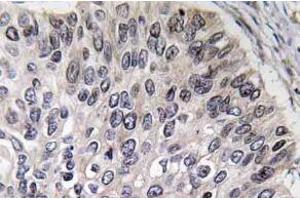 Immunohistochemistry analyzes of Carbonic anhydrase 2 antibody in paraffin-embedded human lung carcinoma tissue. (CA2 antibody)