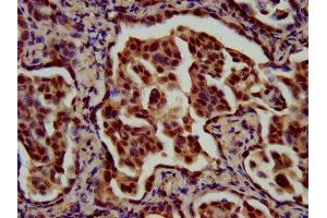 IHC image of ABIN7159682 diluted at 1:700 and staining in paraffin-embedded human lung cancer performed on a Leica BondTM system. (RFX1 antibody  (AA 36-133))