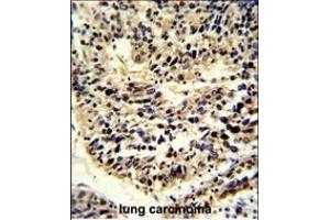 Formalin-fixed and paraffin-embedded human lung carcinoma reacted with BCL2A1 Antibody (Center), which was peroxidase-conjugated to the secondary antibody, followed by DAB staining. (BCL2A1 antibody  (AA 53-81))