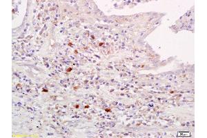 Formalin-fixed and paraffin embedded human lung carcinoma labeled with Anti-Amylin Polyclonal Antibody, Unconjugated (ABIN724280) at 1:200 followed by conjugation to the secondary antibody and DAB staining. (Amylin/DAP antibody)