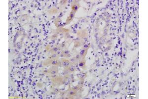 Formalin-fixed and paraffin embedded human hepatoma labeled with Anti-phospho C-Met/HGFR(Tyr1365), Unconjugated (ABIN733703) at 1:200, followed by conjugation to the secondary antibody and DAB staining (MEK1 antibody  (pSer298))