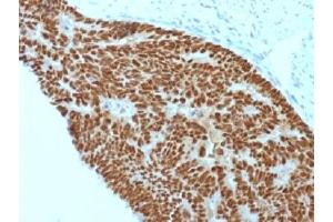 IHC testing of FFPE human colon carcinoma with CDX2 antibody (clone CDX2/1690). (CDX2 antibody  (AA 150-249))