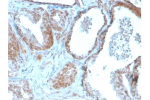Formalin-fixed, paraffin-embedded human Prostate Carcinoma stained with TIGIT-Monospecific Mouse Monoclonal Antibody (TIGIT/3106). (TIGIT antibody  (AA 22-141))