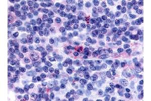 Immunohistochemical staining of Lymph node (Hodgkin's disease) using anti- GPR65 antibody ABIN122423