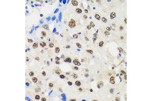 Immunohistochemistry of paraffin-embedded Human breast cancer using LB Rabbit pAb (ABIN6131871, ABIN6143090, ABIN6143091 and ABIN6217142) at dilution of 1:100 (40x lens). (LARP1B antibody  (AA 170-320))