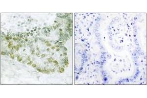 Immunohistochemistry analysis of paraffin-embedded human lung carcinoma tissue, using Hic-5 (Ab-60) Antibody. (TGFB1I1 antibody  (AA 31-80))