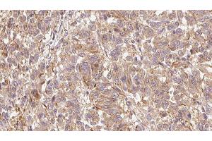 ABIN6279662 at 1/100 staining Human Melanoma tissue by IHC-P. (GPLD1 antibody  (Internal Region))