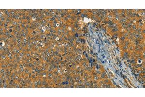 Immunohistochemistry of paraffin-embedded Human cervical cancer using KLC1 Polyclonal Antibody at dilution of 1:40 (KLC1 antibody)