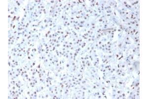 Formalin-fixed, paraffin-embedded human Mesothelioma stained with Wilm's Tumor Mouse Monoclonal Antibody (6F-H2). (WT1 antibody  (AA 1-181))