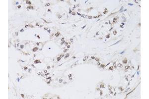 Immunohistochemistry of paraffin-embedded human gastric cancer using PAX3 antibody (ABIN6290725) at dilution of 1:100 (40x lens).