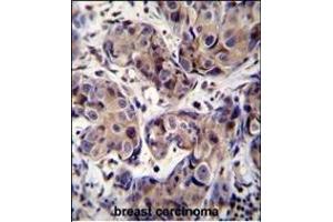 GEA3 Antibody (C-term) (ABIN390107 and ABIN2840619) immunohistochemistry analysis in forlin fixed and paraffin embedded hun breast carcino followed by peroxidase conjugation of the secondary antibody and DAB staining. (MAGEA3 antibody  (C-Term))