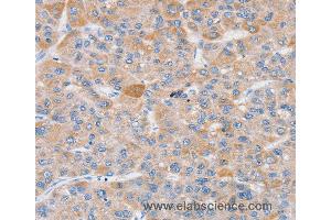 Immunohistochemistry of Human liver cancer using SLC25A13 Polyclonal Antibody at dilution of 1:35 (slc25a13 antibody)