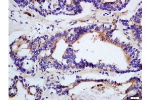Formalin-fixed and paraffin embedded human colon cancer tissue labeled with Rabbit Anti-DHDH Polyclonal Antibody, Unconjugated (ABIN2559590) at 1:200 followed by conjugation to the secondary antibody and DAB staining (DHDH antibody  (AA 281-334))