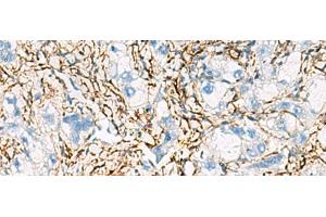 Immunohistochemistry of paraffin-embedded Human liver cancer tissue using ACTC1 Polyclonal Antibody at dilution of 1:55(x200) (ACTC1 antibody)