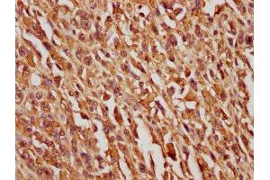 IHC image of ABIN7163445 diluted at 1:100 and staining in paraffin-embedded human melanoma cancer performed on a Leica BondTM system. (PEDF antibody  (AA 128-418))
